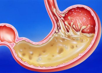 low hydrochloric stomach acid